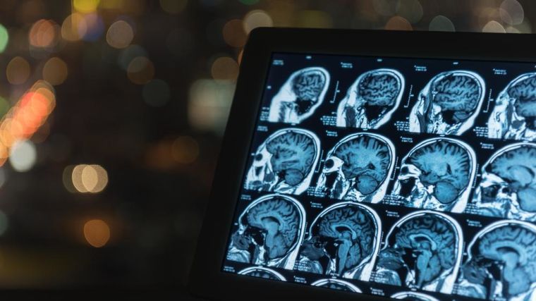 MRI brain scans on a computer screen